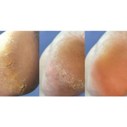 Crema con urea para grietas de talones y manos Podology+ ANTI CRACK CREAM NAILSOFTHEDAY, 30 ml