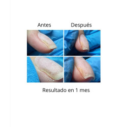 OniStop NAILS OF THE DAY, aceite regenerador para uñas con onicolisis, 15ml