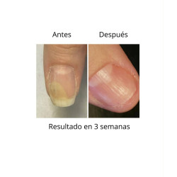 OniStop NAILS OF THE DAY, aceite regenerador para uñas con onicolisis, 15ml
