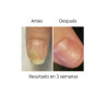 OniStop NAILS OF THE DAY, aceite regenerador para uñas con onicolisis, 15ml