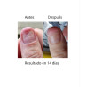 OniStop NAILS OF THE DAY, aceite regenerador para uñas con onicolisis, 15ml