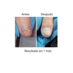 OniStop NAILS OF THE DAY, aceite regenerador para uñas con onicolisis, 8ml