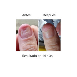 OniStop NAILS OF THE DAY, aceite regenerador para uñas con onicolisis, 8ml