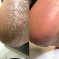 Queratolítico con urea para pedicura  Podology+ Nailsoftheday, 100ml