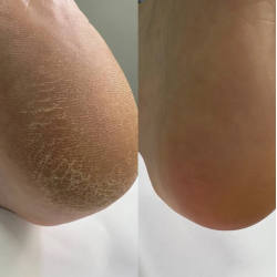 Queratolítico con urea para pedicura  Podology+ Nailsoftheday, 100ml